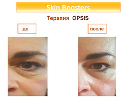 ОПСИС набор для омоложения области вокруг глаз (альтернатива блефаропластике) 2 предмета - Juliette armand фото 2