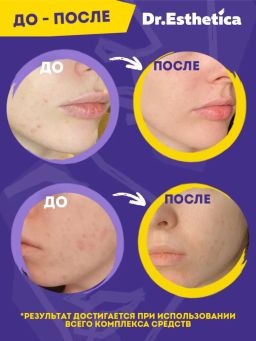 NO ACNE TEENS Крем-актив, 50 мл dr. esthetica  фото 6