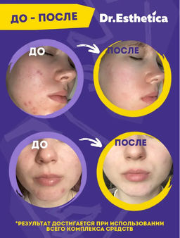 Пузырьковая мульти-маска PINK&GREEN 6+6 г DR. ESTHETICA NO ACNE TEENS  фото 8