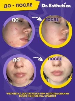 Очищающая пенка-актив, 200 мл dr. esthetica NO ACNE TEENS  фото 6