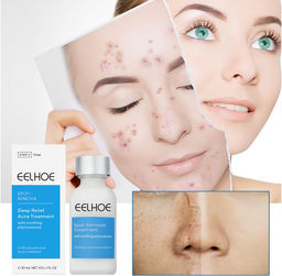 Осветляющая сыворотка от прыщей, 30 мл