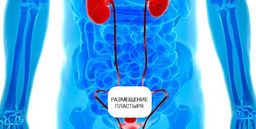Пластырь от простатита Prostatic Navel Plasters до 2018 . 03 - Elaimei фото 4