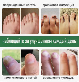 Крем для лечения грибка ногтей 30гр - Buro фото 2