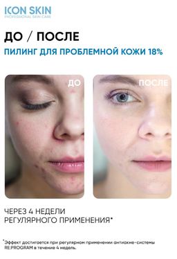 Пилинг для лица с 18% комплексом кислот. Лечение тяжелой степени акне. Для проблемной и комбинирован - Icon skin фото 11