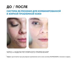 ICON SKIN Косметический набор для лечения акне легкой степени. 4 средства.  фото 4