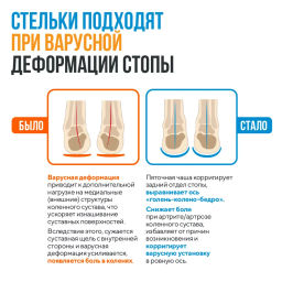 Каркасные ортопедические стельки Talus 57 флекс при болях в коленях, при плоскостопии, при варусе  фото 13