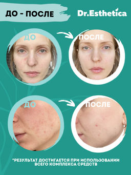 DR. ESTHETICA NO ACNE ADULTS Двухэтапная очищающая грязевая маска, 3+10 г