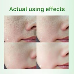 Крем для удаления акне с салициловой кислотой, 30 мл - Bioaqua фото 6