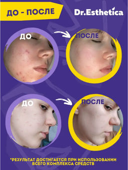 DR. ESTHETICA NO ACNE TEENS Пузырьковая мульти-маска YELLOW&VIOLET, 6+6 г 3 шт  фото 9