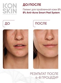 Деликатный пилинг для лица с 8% комплексом кислот. Для проблемной, склонной к сухости кожи. 30мл - Icon skin фото 3